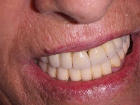 Fotos reales de implantes dentales